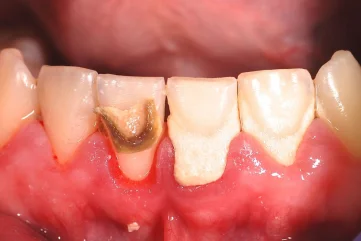Tartar Oluşumunu Önlemek İçin Ne Yapmalısınız? - Moon Dental Alanya Blog