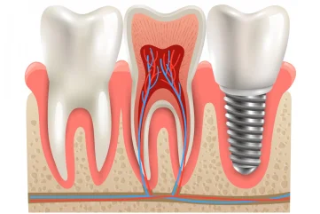 Qu’est-ce qu’un implant dentaire et combien de temps cela prend-il ? Toutes les étapes. - Moon Dental Alanya Blog
