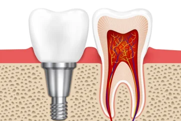 Alanya'da Sağlıklı Gülüşler İçin Diş İmplantı Tedavisi - Moon Dental Alanya Blog
