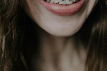 Schöne Lächeln mit spezialisierter kieferorthopädischer Behandlung in der Alanya Zahnarztpraxis. - Moon Dental Alanya Blog
