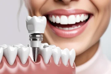 Implant Dentaire à Alanya : Traitement Spécialisé et Technologies Modernes des Implants | Guide 2025 - Moon Dental Alanya Blog