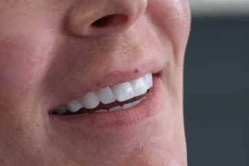 Пусть ваша улыбка будет переработана: создание улыбки в Аланье - Moon Dental Alanya Blog