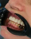 Unterschiede zwischen Implantaten und Kronen in Alanya: Welche Behandlung ist die richtige für Sie