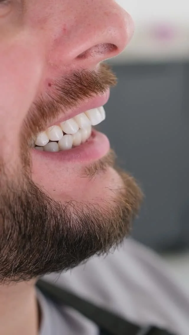 Is Getting Laminate Veneers in Alanya a Smart Choice?