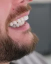 Is Getting Laminate Veneers in Alanya a Smart Choice?