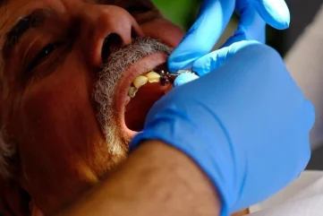 Причины и лечение кровотечения десен в Аланье: подробное руководство - Moon Dental Alanya Blog