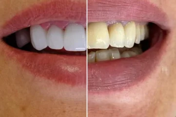 Ежедневные процедуры по уходу за зубами в Аланье - Moon Dental Alanya Blog