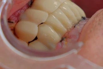 Spezielle Zahnbehandlung für Raucher in Alanya: Rauchen und Mundgesundheit - Moon Dental Alanya Blog
