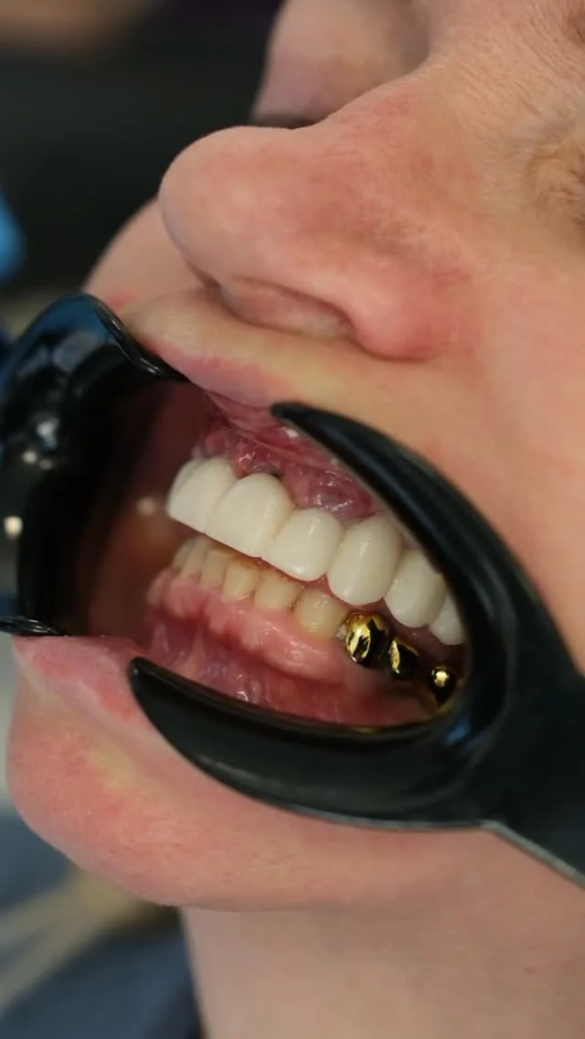 Pourquoi la santé des gencives est-elle aussi importante que votre sourire à Alanya ?
