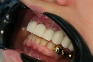 Pourquoi la santé des gencives est-elle aussi importante que votre sourire à Alanya ? - Moon Dental Alanya Blog